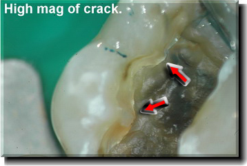 Cracked tooth.jpg